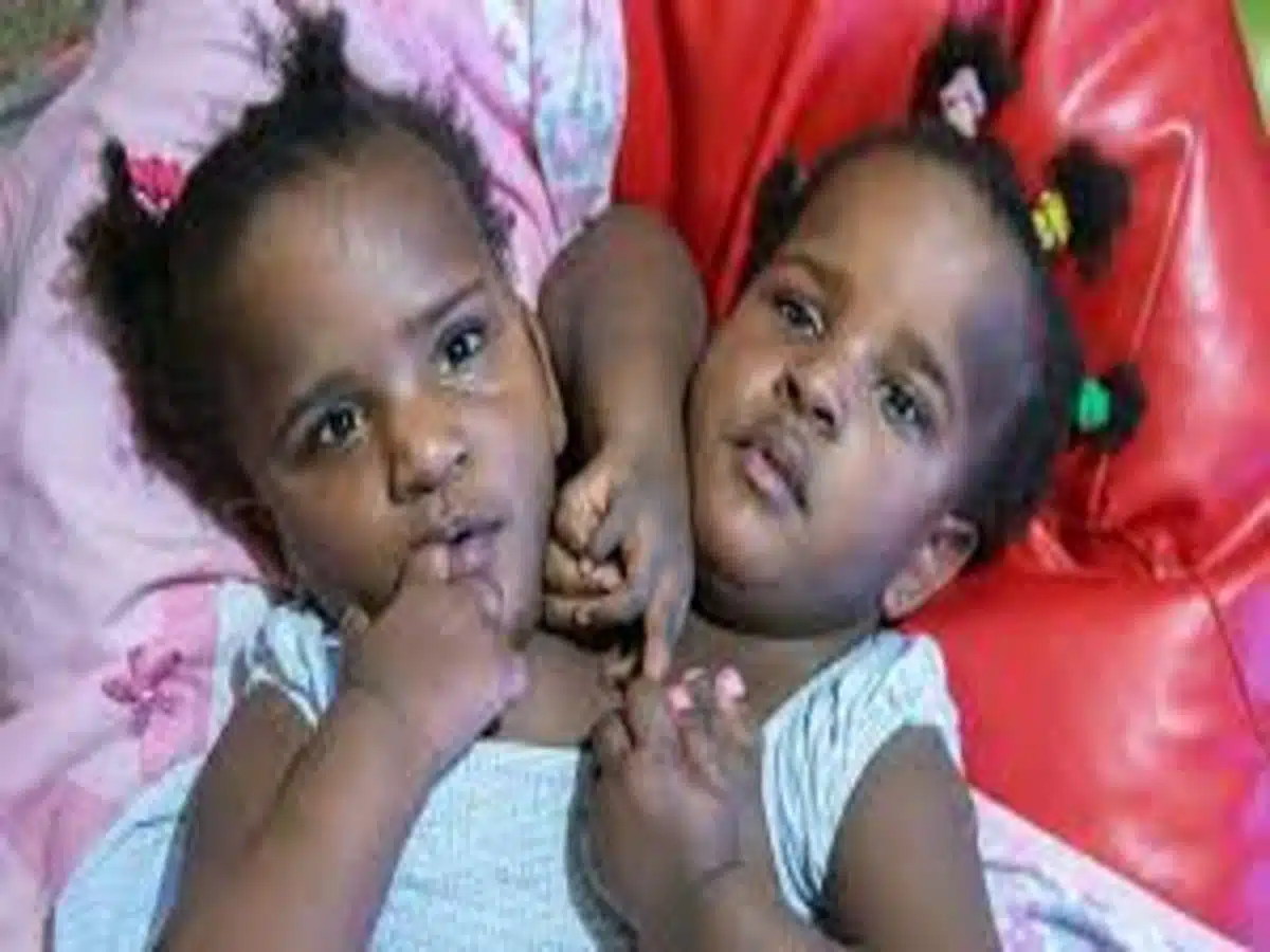 Senegalese conjoined twins Marieme and Ndeye finally get their own coats