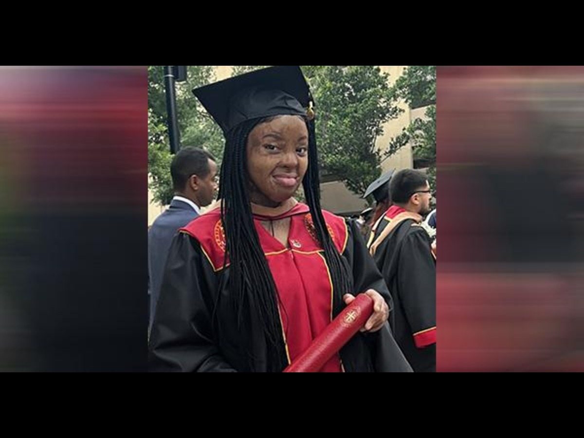 This Nigerian plane crash survivor underwent over 100 surgeries and earned a master’s degree against all odds